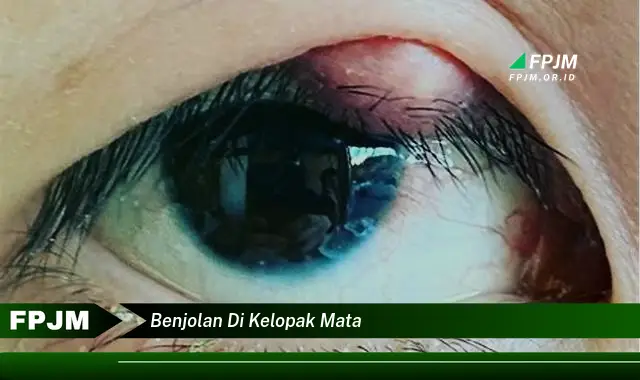 benjolan di kelopak mata benjolan di kelopak mata