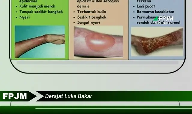 derajat luka bakar