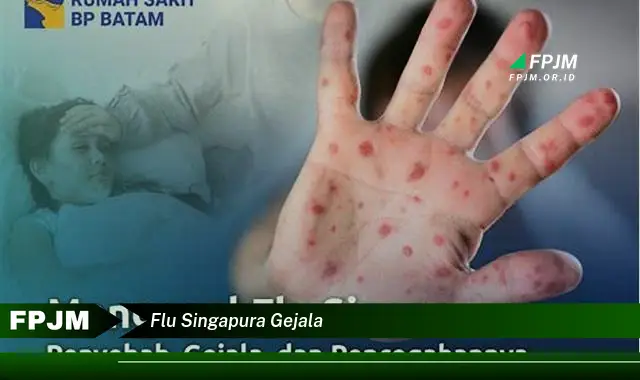 flu singapura gejala