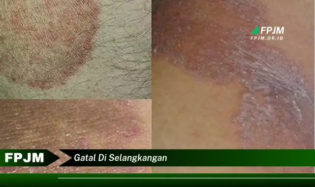 gatal di selangkangan