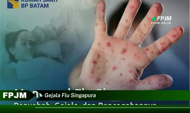 gejala flu singapura