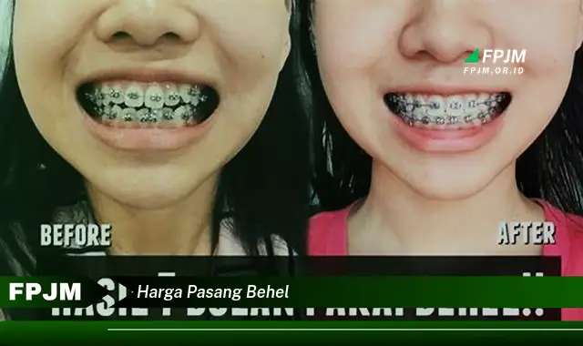 harga pasang behel