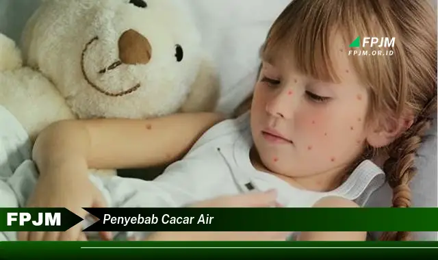 penyebab cacar air