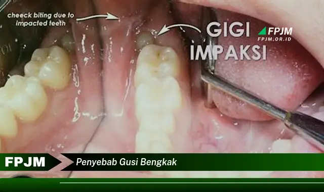 penyebab gusi bengkak